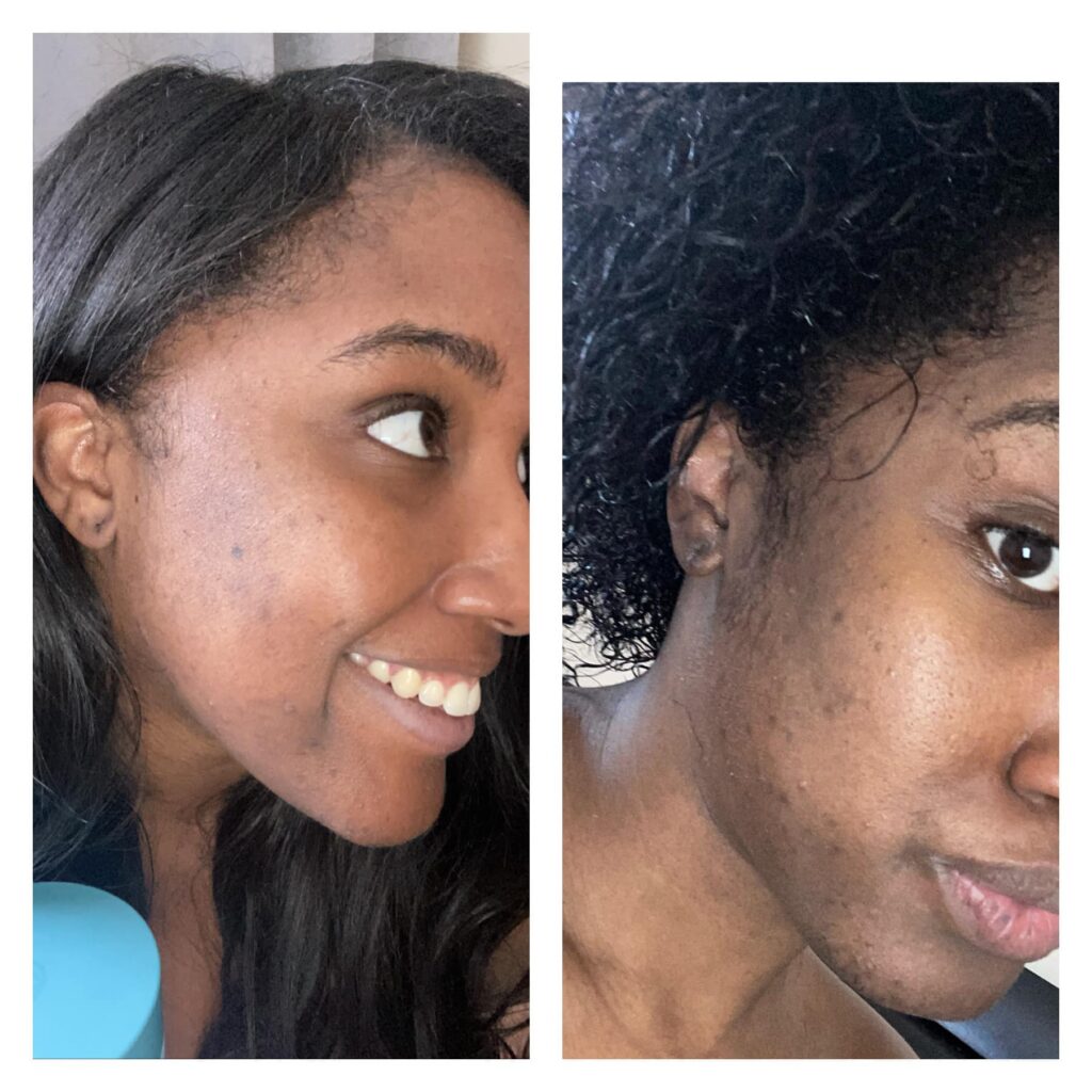 dark skin sunspot removal